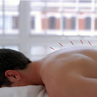 Acupuncture on man's back