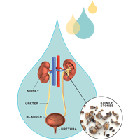 Kidney stones diagram