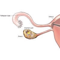 Diagram of ovarian cyst