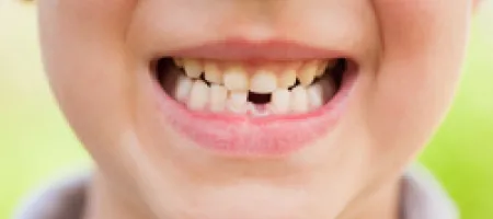 Boy grinning with missing tooth