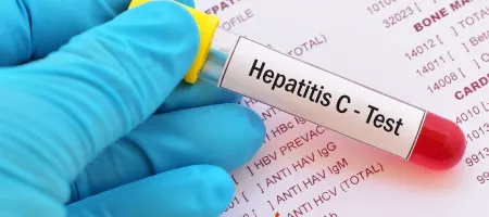 Hepatitis C, Medical Test, Medical Exam, Hepatitis, Scientific Experiment