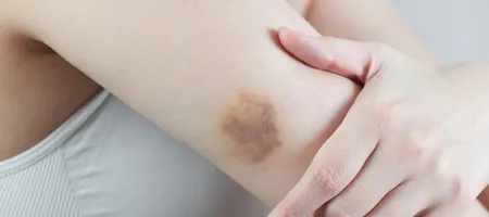 What You Should Know About Hematomas